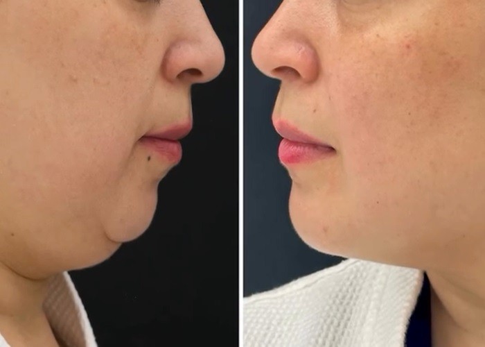 non surgical double chin reduction in dubai
