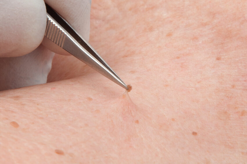 Can Skin Tag Removal Make Skin Look Smoother and Clearer