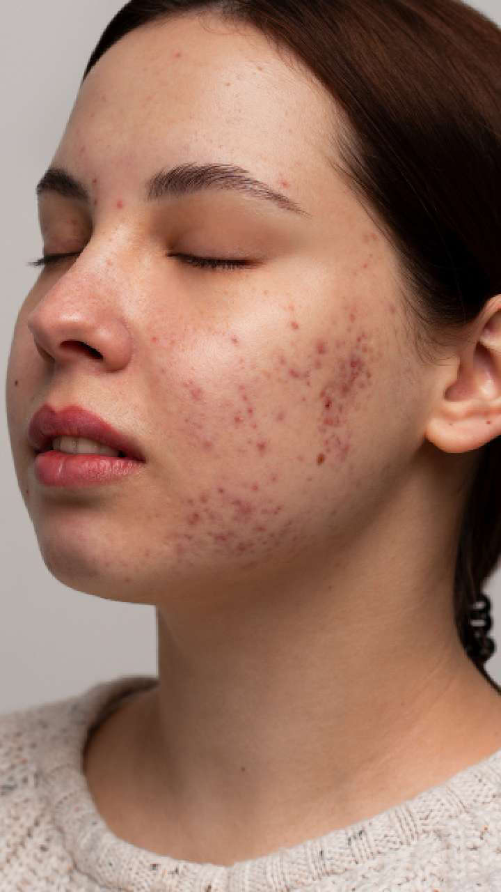 Can The Best Acne Treatment Remove Acne Permanently 2