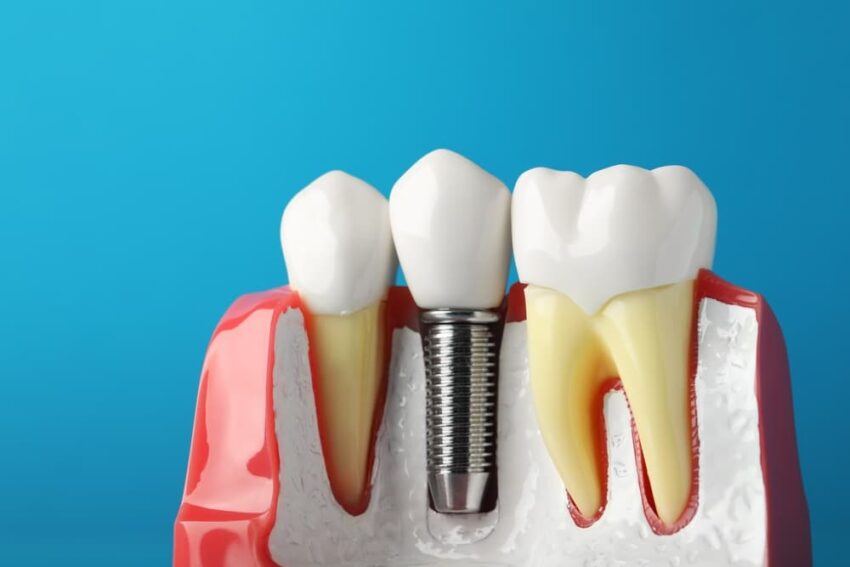 dental implants 1