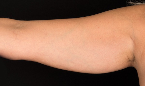 imageye imgi 39 61c7972ccf62c52e13064790 arm before