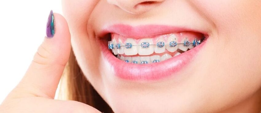 braces