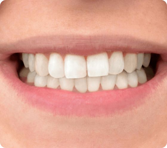 teeth whitening after2