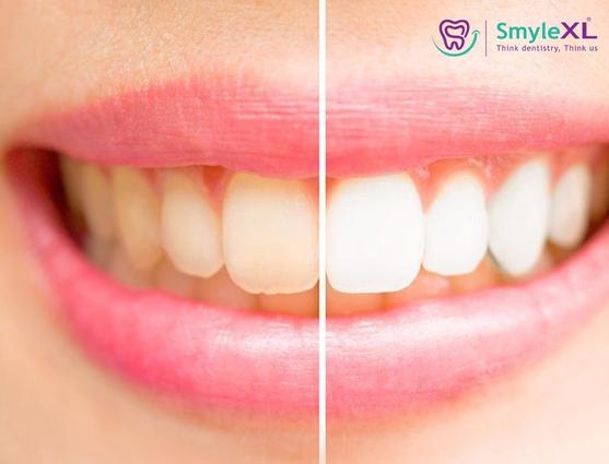Teeth Whitening