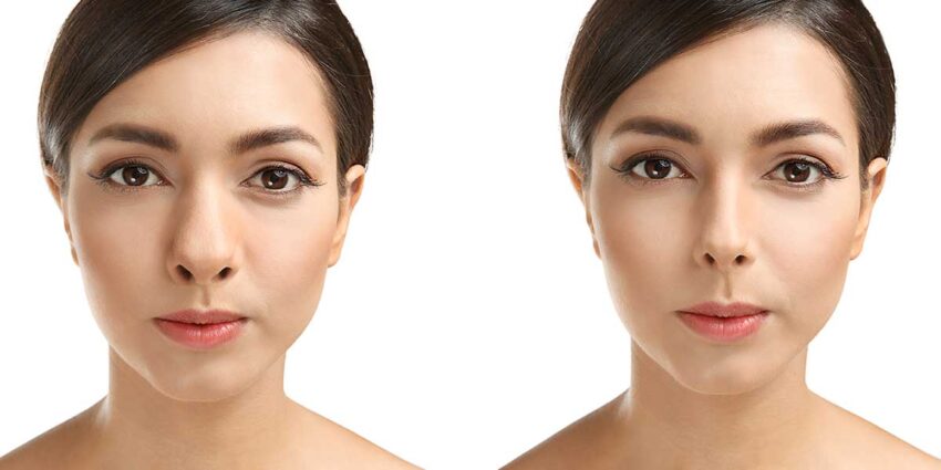 Can Rhinoplasty Correct a Saddle Nose Deformity