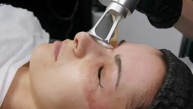 Fractional CO2 Skin Resurfacing in Islamabad 1