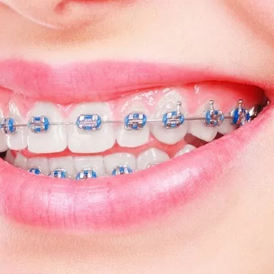 Dental Braces in Dubai