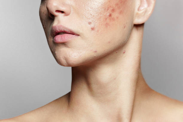 Pimples Treatment in Riyadh 9