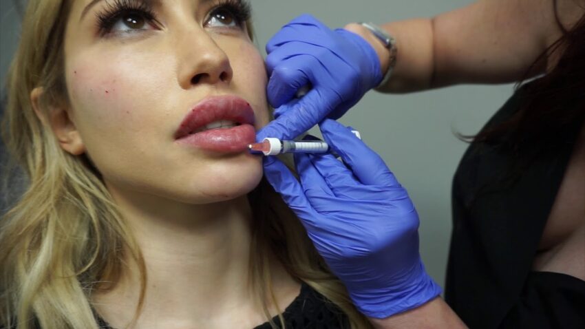 Can Lip Fillers Restore Volume Lost With Aging