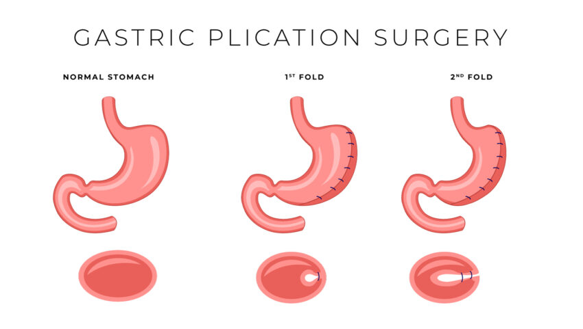 Why Do People Choose Gastric Plication for Obesity
