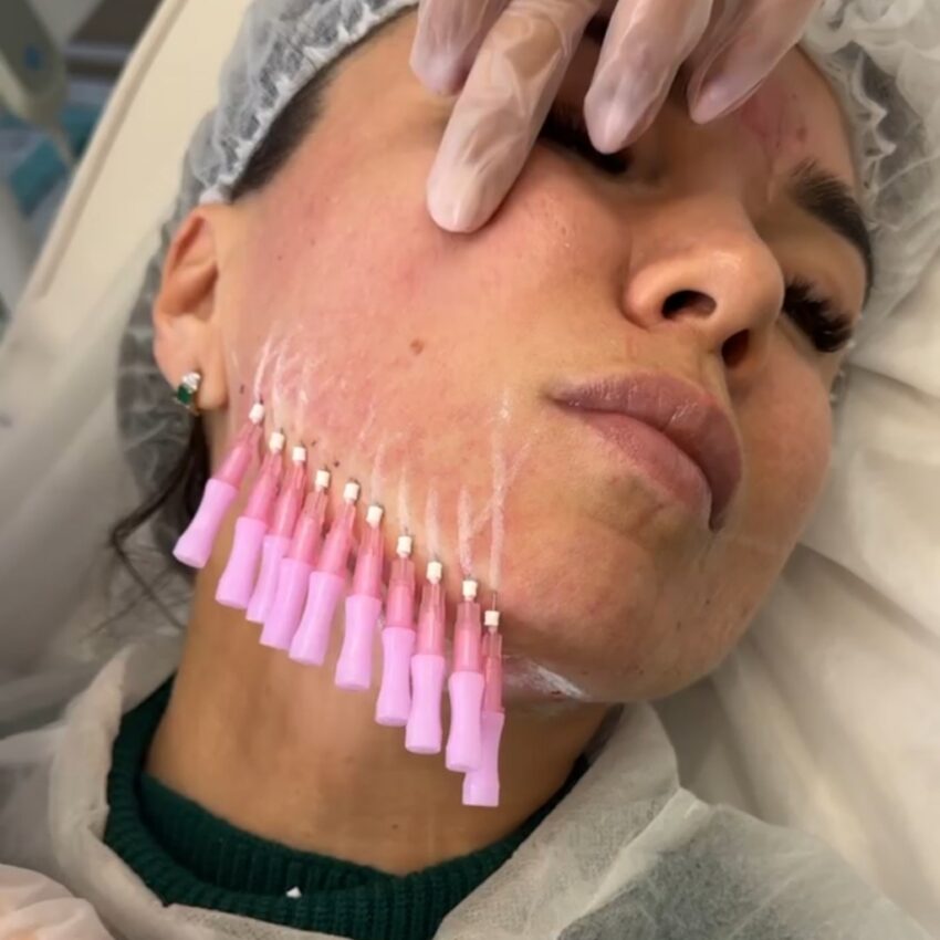 Why Are PDO Mono Threads Used for Facial Rejuvenation