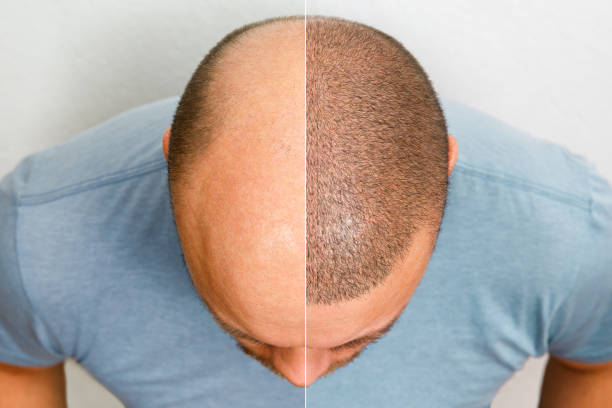 Hair Transplant in Riyadh 23