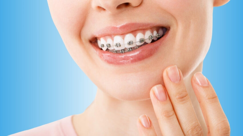 Braces Treatment 2