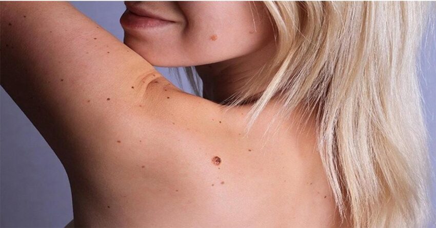 wart removal