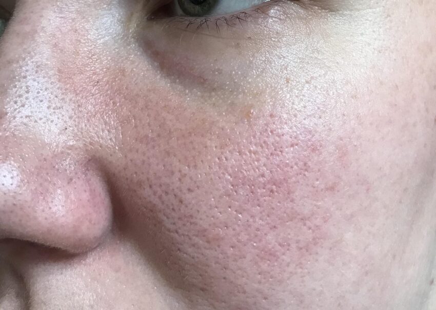 What Skin Types Benefit Most From Large Pores Treatment