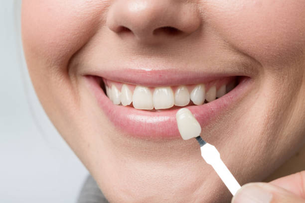 dental veneers hinjewadi 1