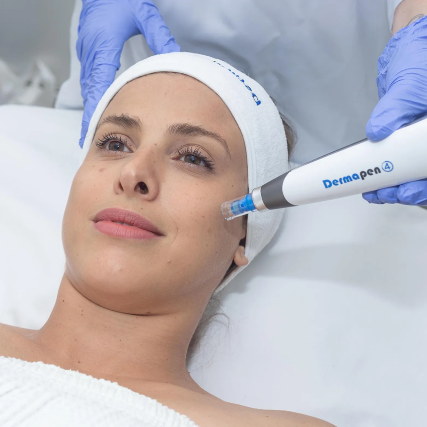 Can Dermapen Microneedling Reduce Acne Scar Appearance