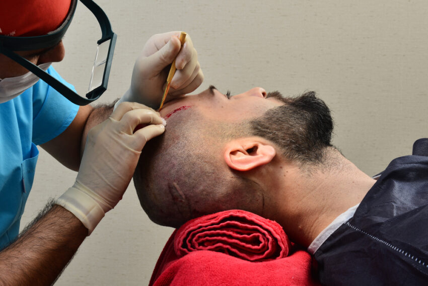 How Does Hair Transplant Provide Long Lasting Hair Growth