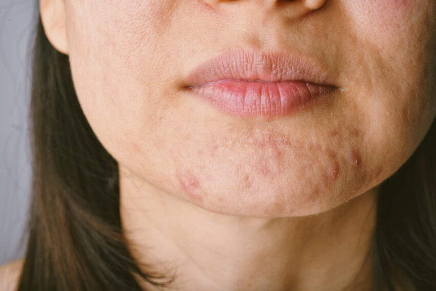 What Are the Latest Acne Treatments