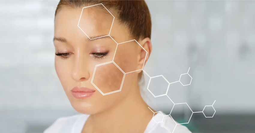Melasma Treatment