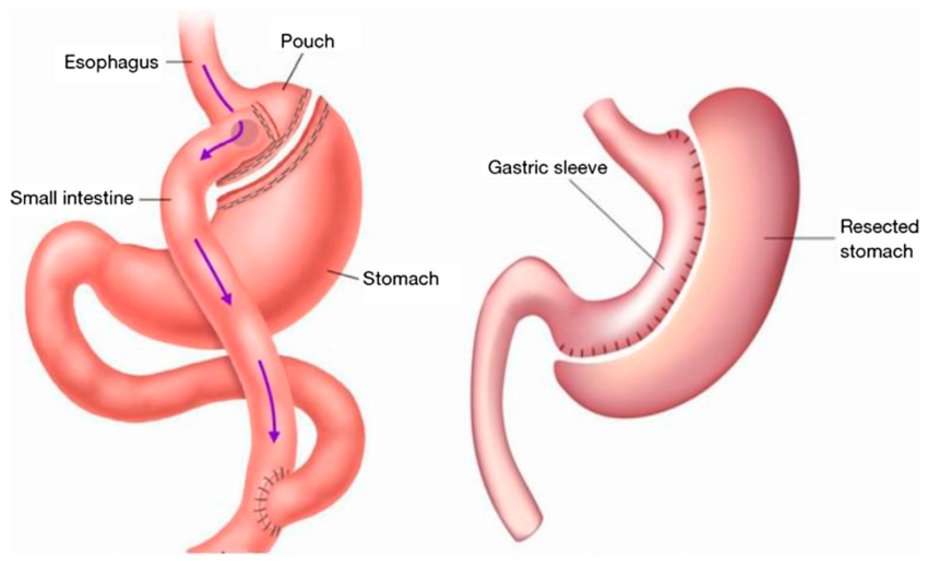 How Does Gastric Bypass Surgery Actually Work for Weight Loss