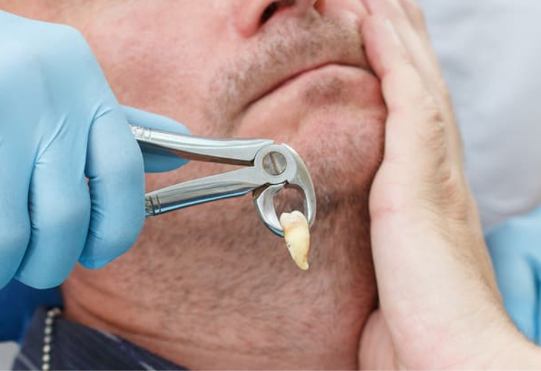 wisdom tooth