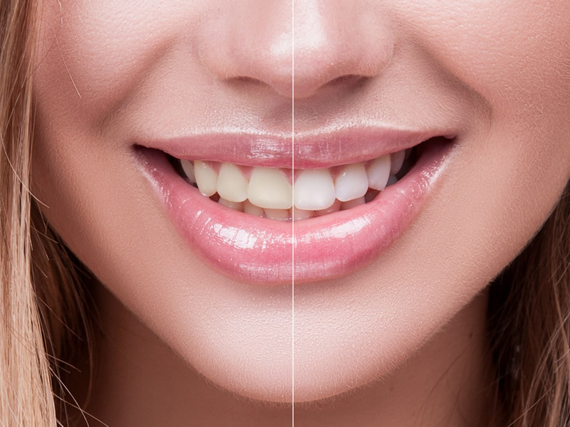 tooth whitening