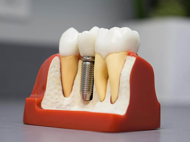 Dental Implant