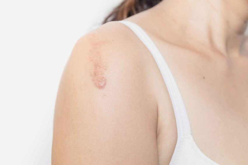 Can Keloid Treatment Permanently Remove Raised Scars