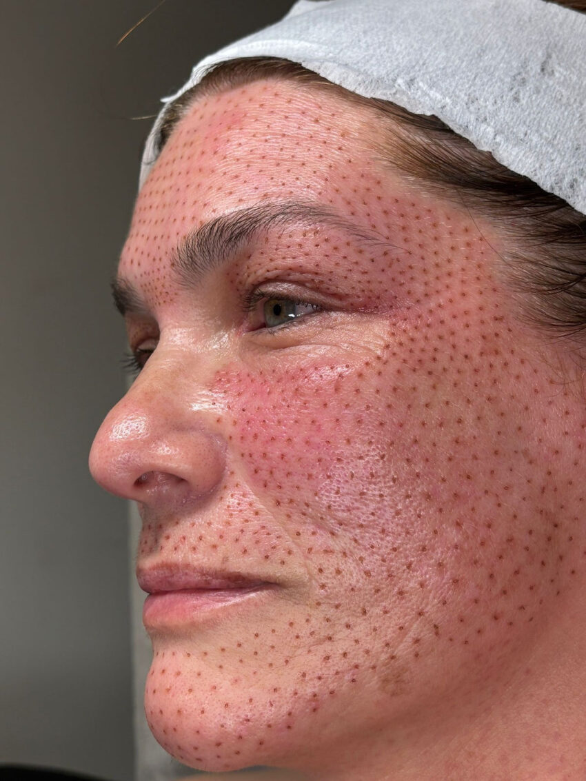 Can Plasma Pen Treatment Improve Deep Facial Wrinkles