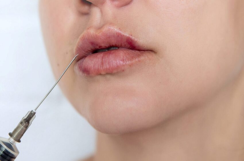 How Much Volume Should You Get With Lip Filler Injections