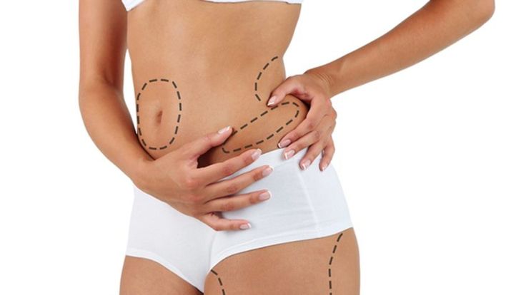 Laser Liposuction in Dubai4
