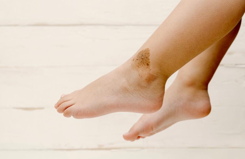 Is Birthmarks Removal Treatment Worth It