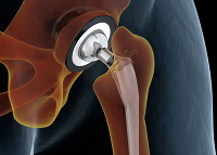 hip replacement