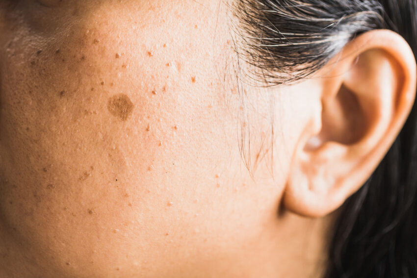 Can Dermal Pigmentation Treatment brighten the skin