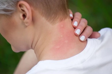 Parasite Infections