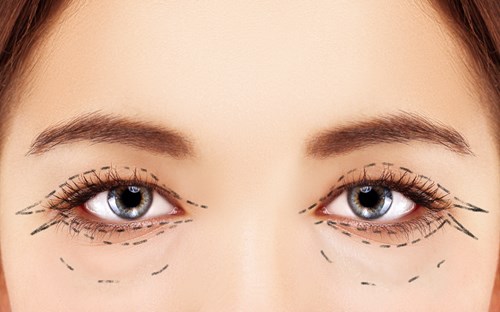 eyelid surgery