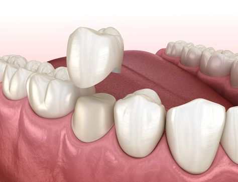 dental crown cost zirakpur