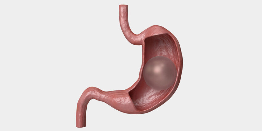 Gastric Balloon 1 1