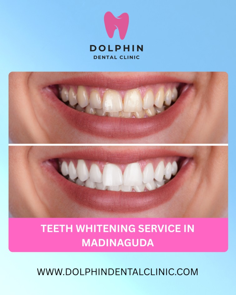 Teeth Whitening Service in Madinaguda