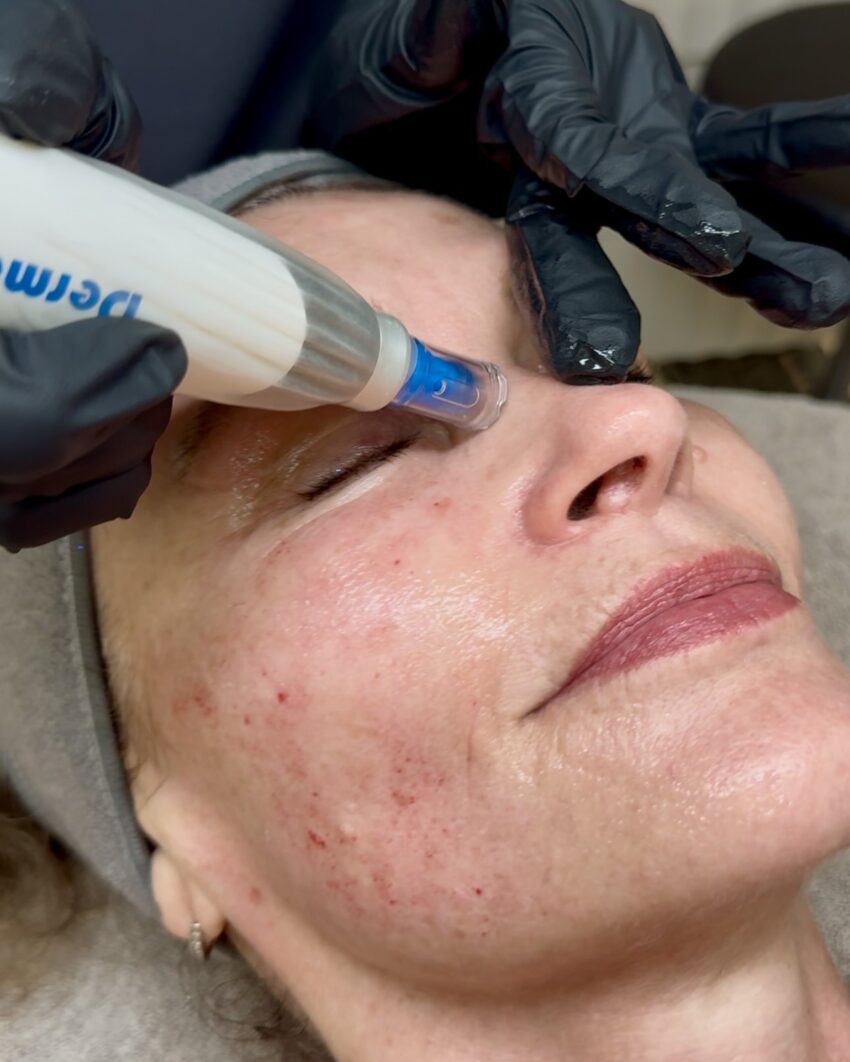 Why Are Adults Over 50 Choosing Dermapen Treatment