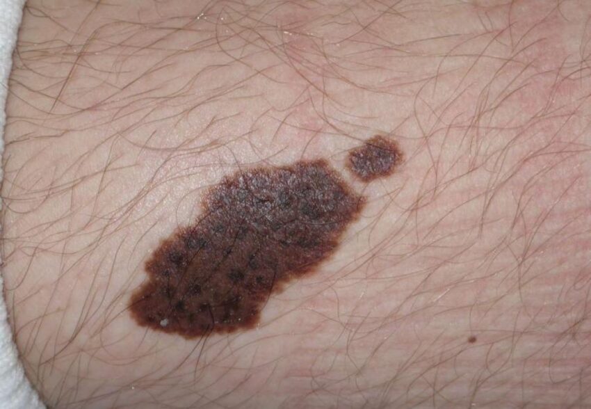 What are the latest Birthmarks Removal Treatment technologies