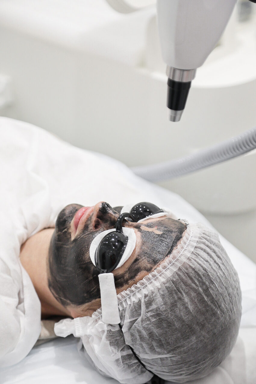 Who Should Get Laser Carbon Peel