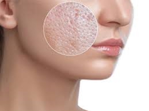 Which Large Pores Treatment option is best