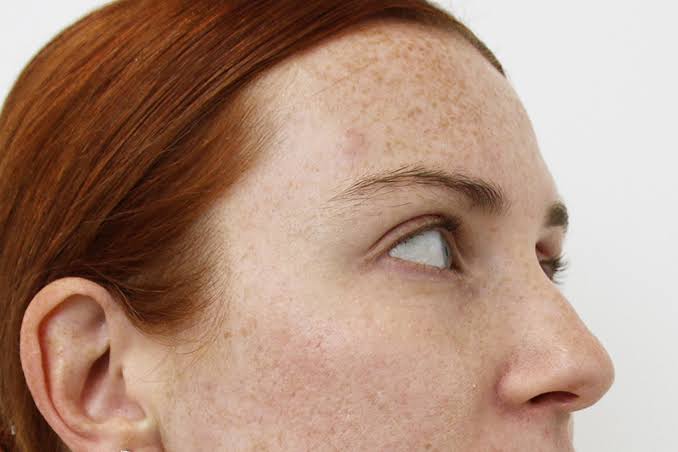 Is Dermal Pigmentation Treatment suitable for skin concern