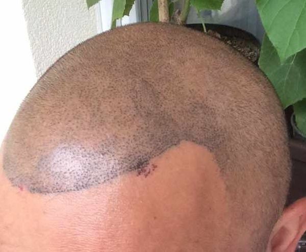 What is Scalp Micropigmentation used for