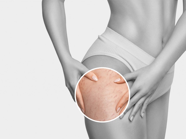 Is Stretch Marks Removal safe