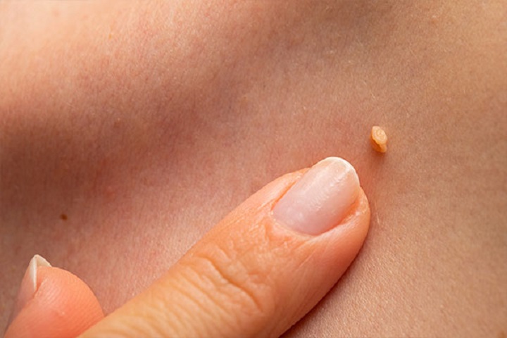 How are skin tags removed