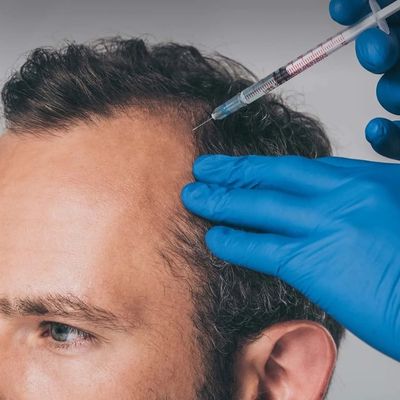 PRP treatment for hair
