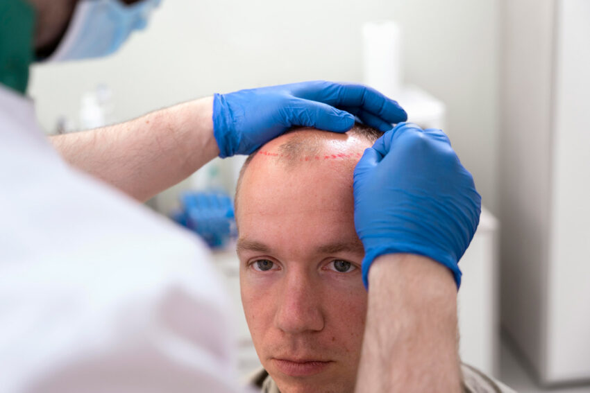 Is a Crown Hair Transplant Worth It in 2026